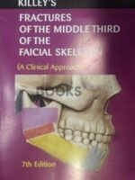 Killeys Fracture of the Middle Third of the Facial Skeleton